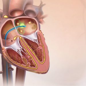 Ablation par radiofréquence de fibrillation auriculaire