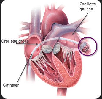 Illustration d'une fermeture percutané d'auricule gauche pour le traitement de la fibrillation atriale